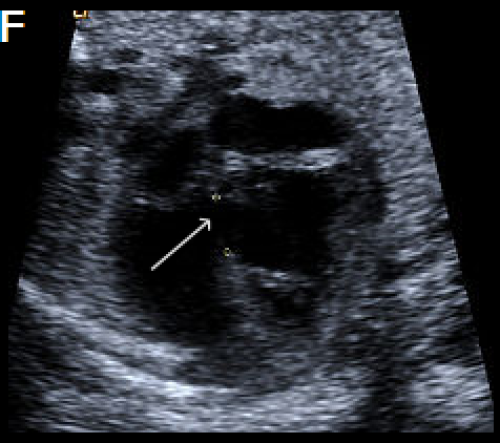 Ultrasound showing interruption of the aortic arch 