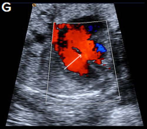 Ultrasound showing interruption of the aortic arch