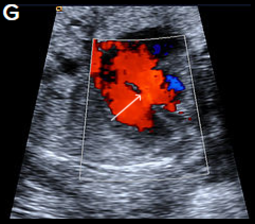 Ultrasound showing interruption of the aortic arch 