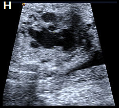 Ultrasound showing interruption of the aortic arch