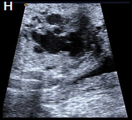 Ultrasound showing interruption of the aortic arch 