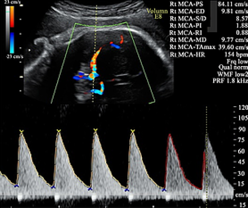 Doppler scan showing middle cerebral artery peak systolic velocity