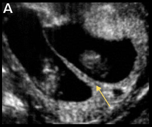 Ultrasound image of dichorionic twins