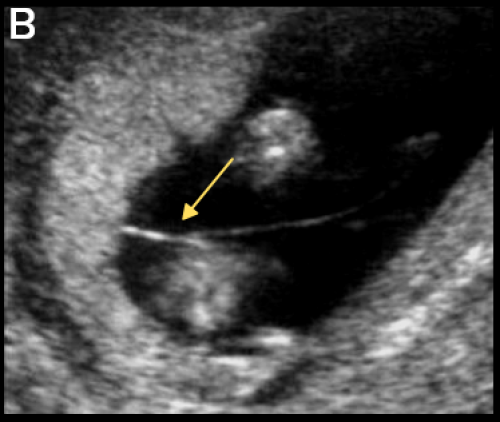 Ultrasound image of monochorionic twins