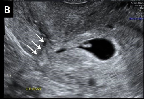 Early placenta accreta / abnormally implanted trophoblast / placenta