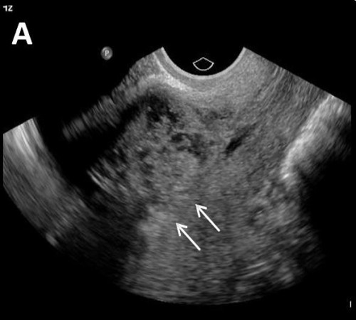 Early placenta accreta / abnormally implanted trophoblast / placenta