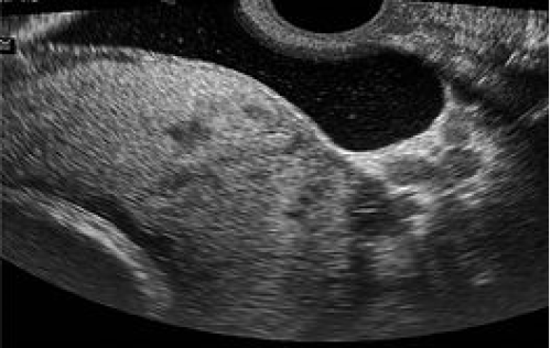 Placenta Highly suspicious for placenta accreta on greyscale imaging.