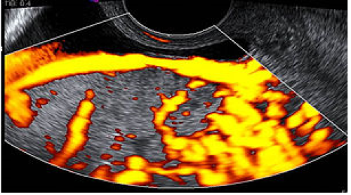placenta highly suspicious for placenta accreta on colour Doppler imaging.