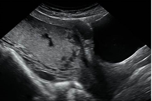 Complete placenta previa.
