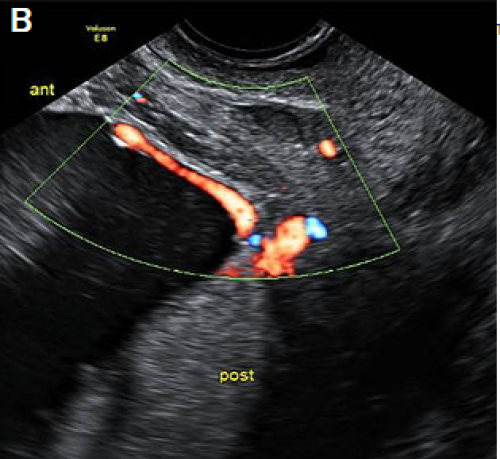 Placenta Type II vasa previa, with vessels coursing over the cervix between the main posterior placental lobe and a smaller anterior succenturiate lobe.