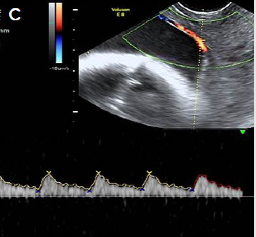 Pulsed Doppler showing a fetal arterial waveform in the vessels crossing the cervix.