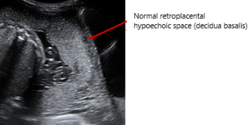 Placenta No evidence of placenta accreta on greyscale imaging.