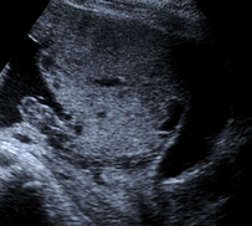 Placenta Highly suspicious for placenta accreta on greyscale imaging.