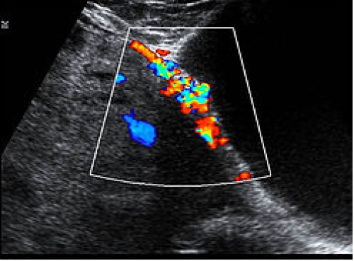 placenta Highly suspicious for placenta accreta on colour Doppler imaging.