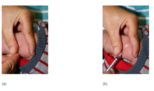 Figure 2.4: The BCG vaccine being slowly injected, and a white weal appearing as the needle is gradually withdrawn
