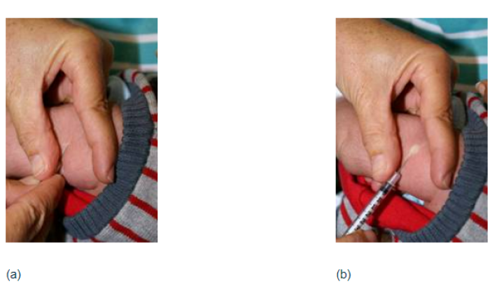 Figure 2.4: The BCG vaccine being slowly injected, and a white weal appearing as the needle is gradually withdrawn