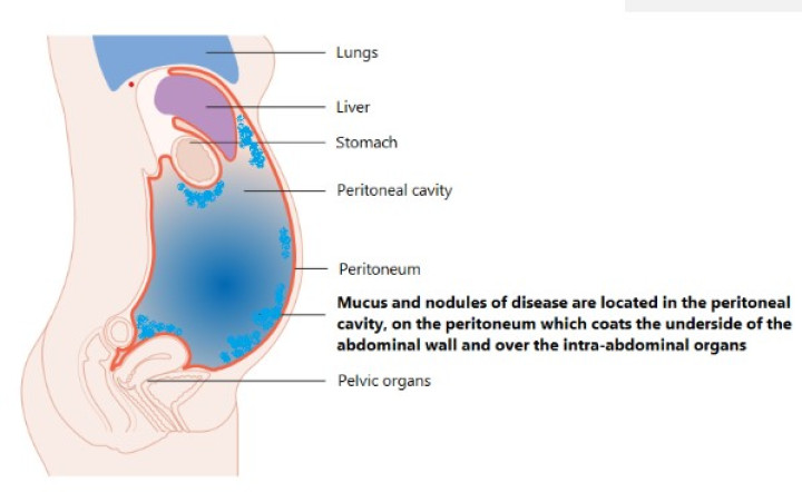 diagram of abdomen showing the disease in pertoneal cavity